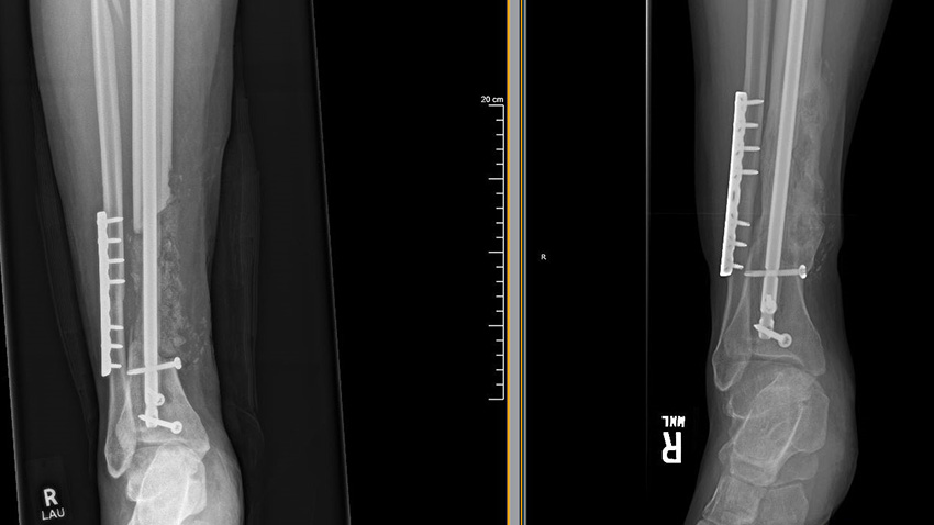 XRAY-New-method-uses-synthetic-bone-to-heal-skeletal-injuries-rapid-news-rapidnews-dailyrapidnews-researchers-lund-university