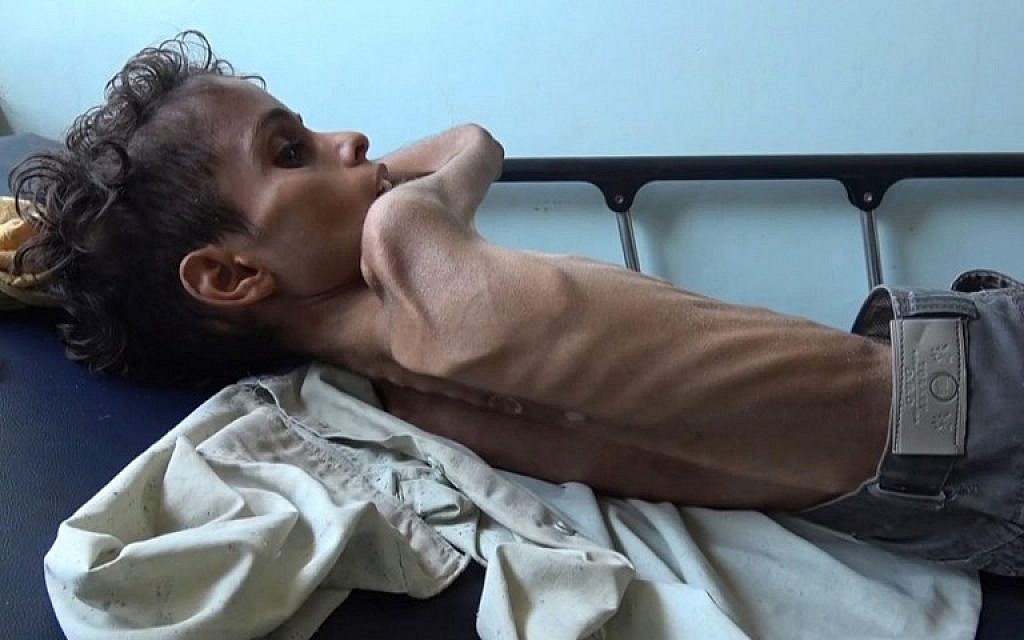 yemeni-boy-ravaged-by-hunger-weighs-7kg-humanitarian-crisis-pakistan-dailyrapid-dailyrapidnews-FADI-fadi