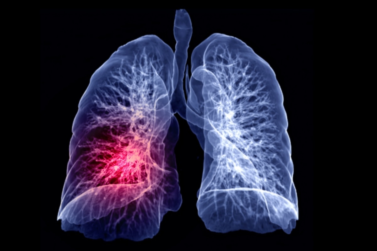 Lung-cancer-resistance-the-key-is-glucose-rapidnews-dailyrapid-dailyrapidnews