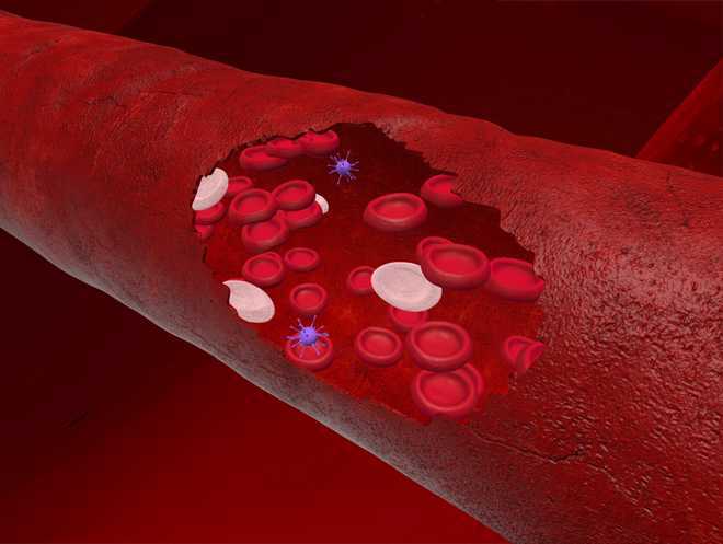 Reports-Suggest-COVID-19-Triggering-Recurrent-Blood-Clots-in-Arms-rapidnews