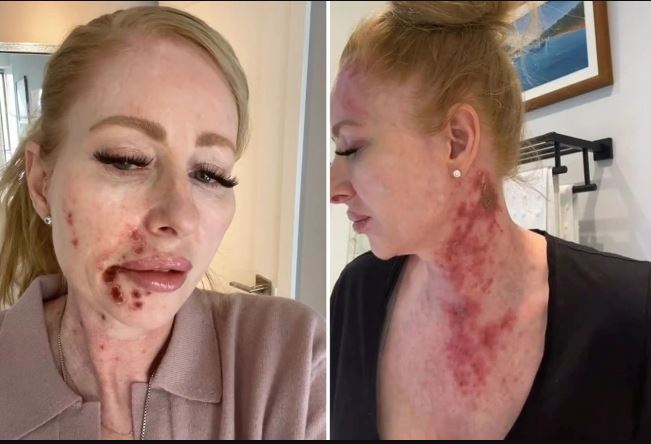 A woman assumed she had eczema on her face but was terrified by the reality.