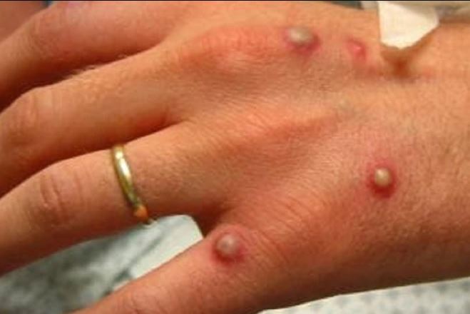 Monkeypox cases continue to climb in the United Kingdom.