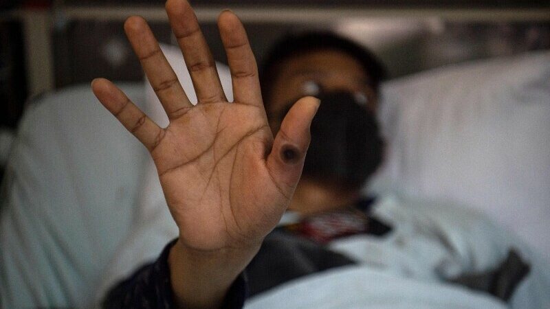 Three Monkeypox cases reported in Pakistan