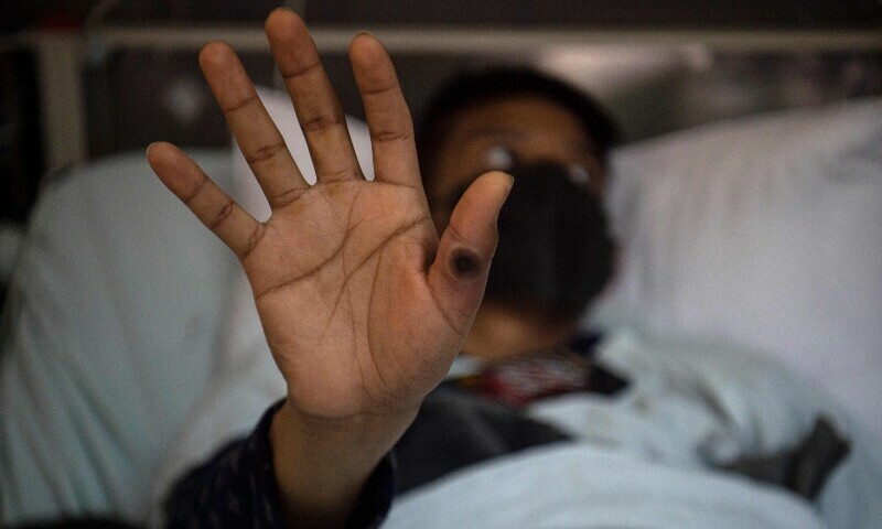 Three Monkeypox cases reported in Pakistan